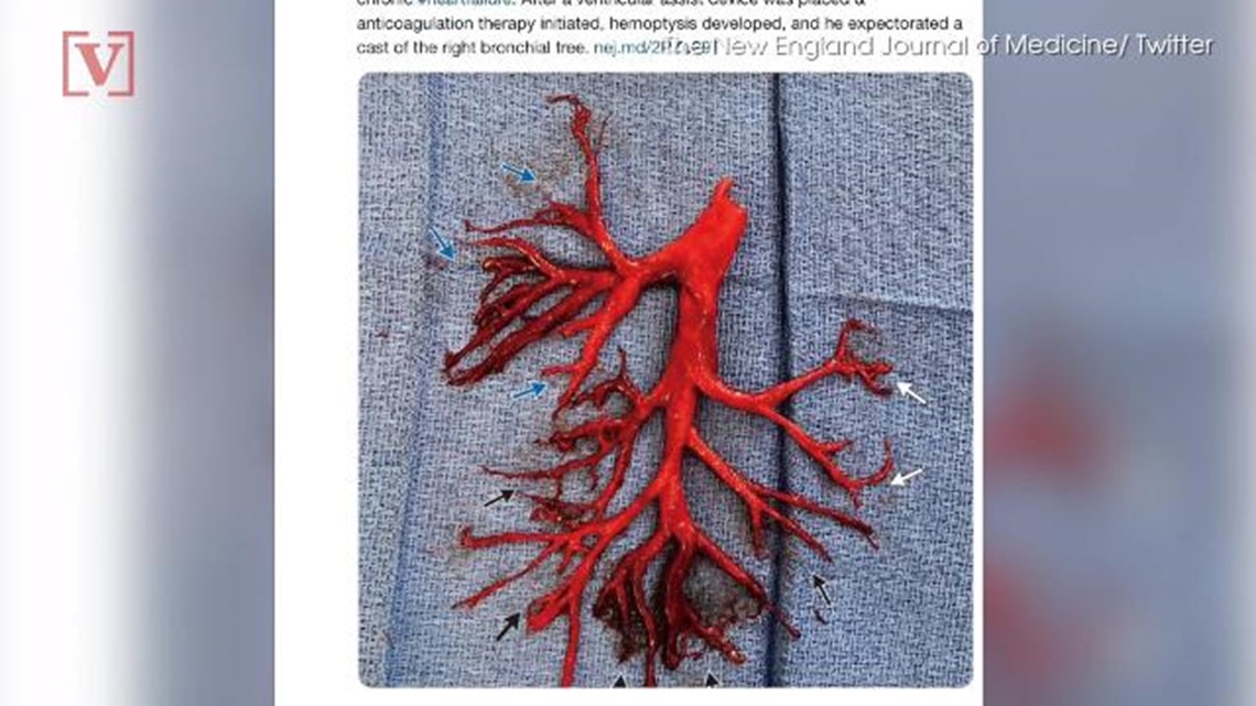 Hamilton Gas Prices >> Man coughs up mysterious blood clot, shocking doctors ... Hamilton Gas Prices >> Man coughs up mysterious blood clot, shocking doctors ...