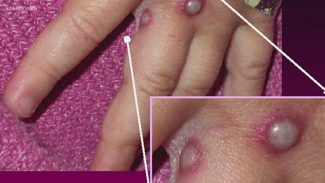 First Monkeypox case reported in McLennan County - Vimarsana News