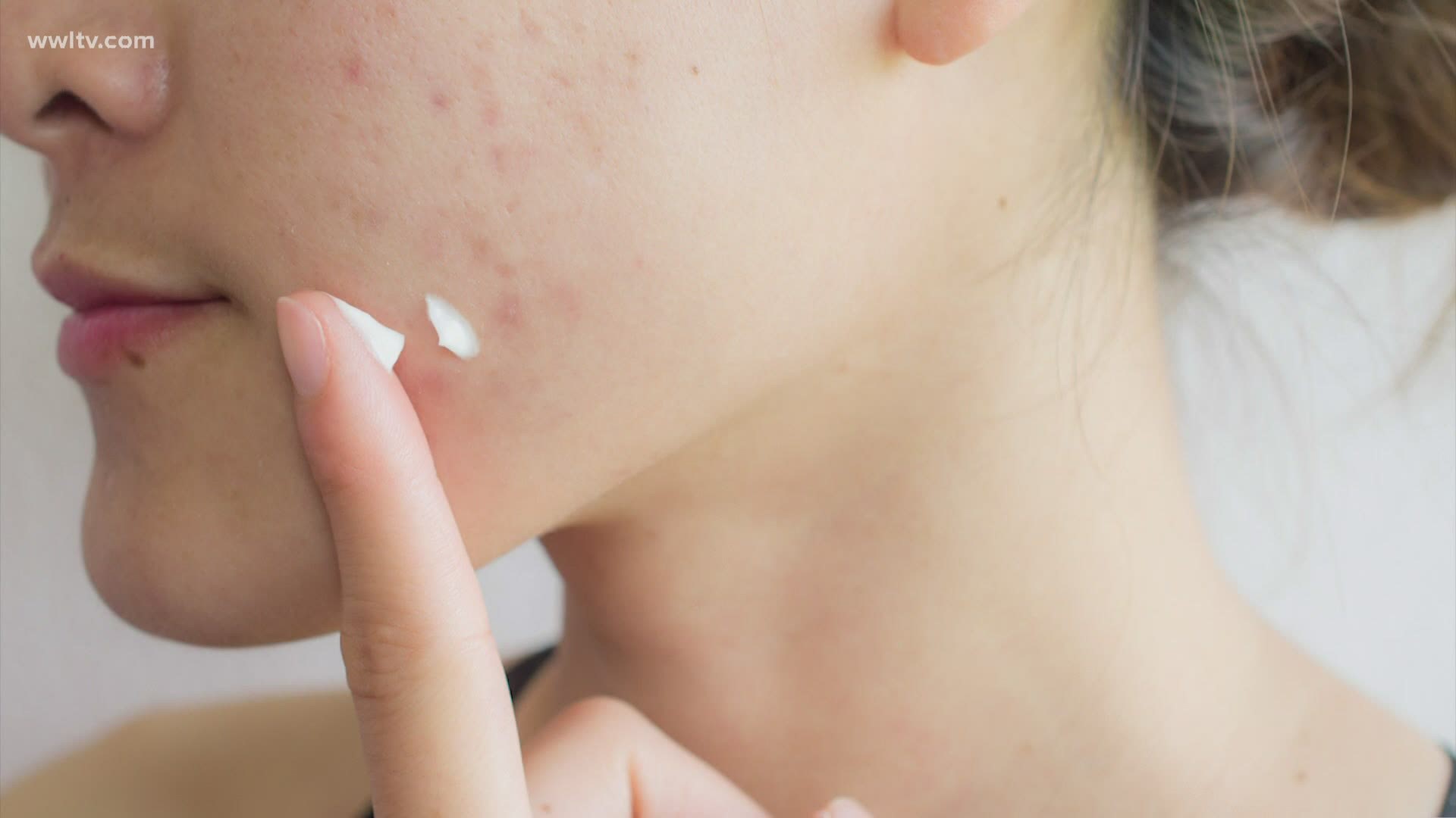 For some women, hormonal acne pops up every month. In this week's "Your Best Life," a hormone expert talks about getting clear skin naturally.