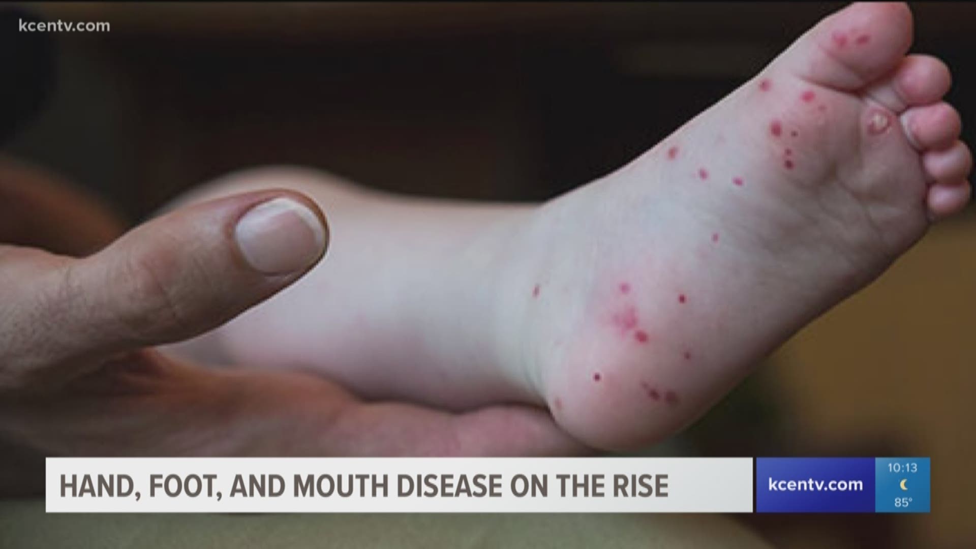 CDC has issued a warning of Hand, Foot and Mouth Disease cases on the rise in multiple states. We spoke with a doctor to see the impact in Central Texas. 