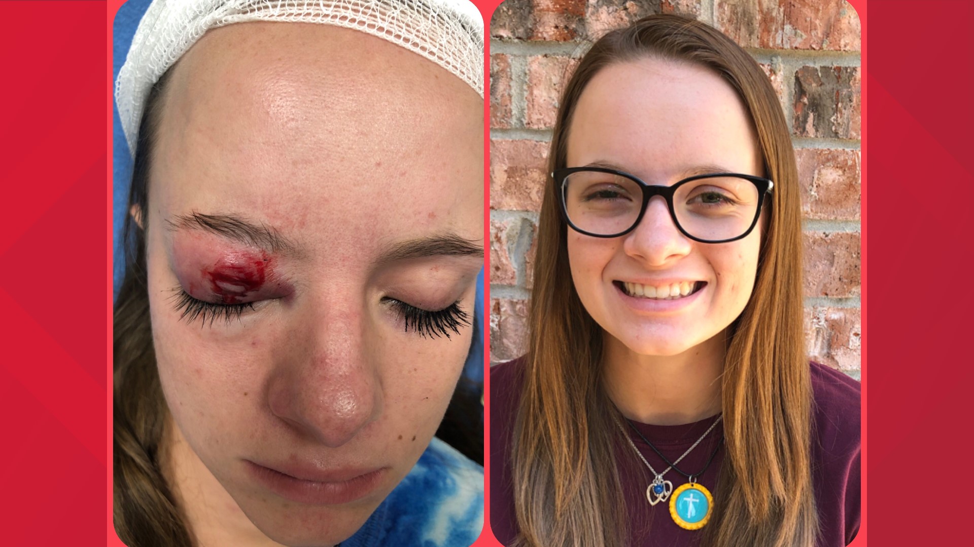 A Waco teen lost sight in her right eye after a firework hit her in the eye on the 4th of July.