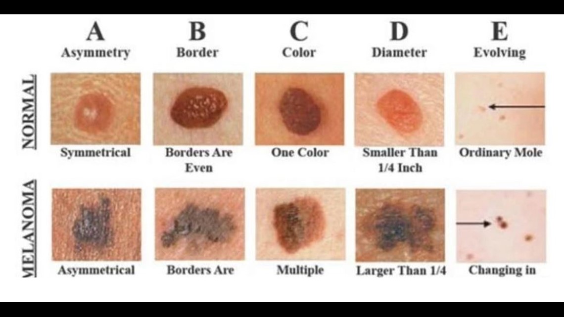 cancerous skin tags