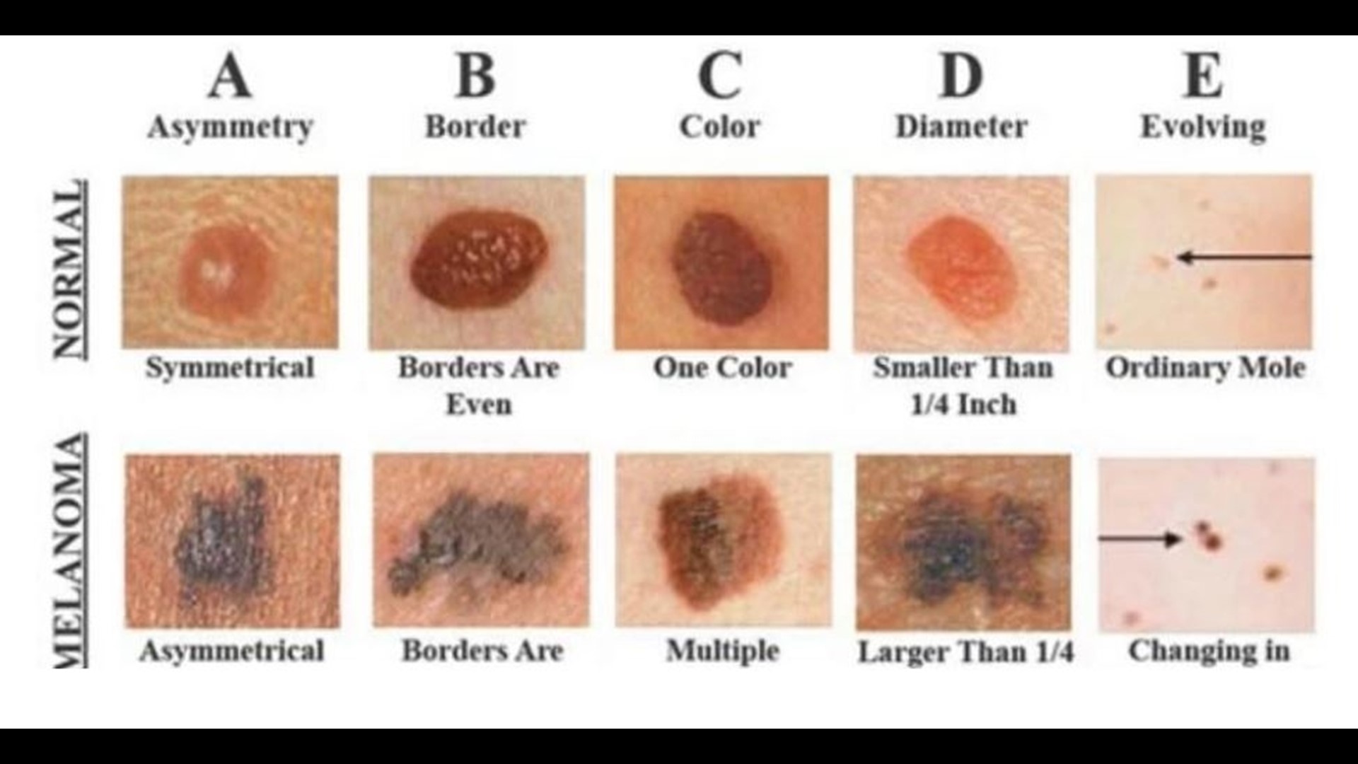 Understanding the hidden dangers of the deadliest of skin cancers  kcentv.com