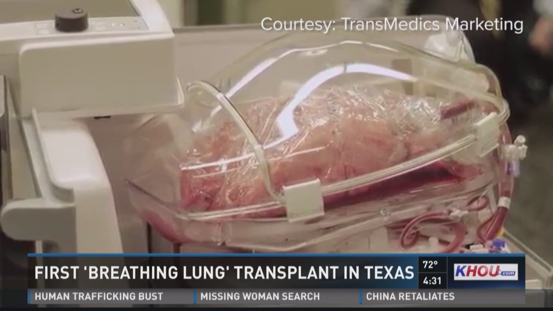Houston hospital first in Texas to complete 'breathing lung' transplant