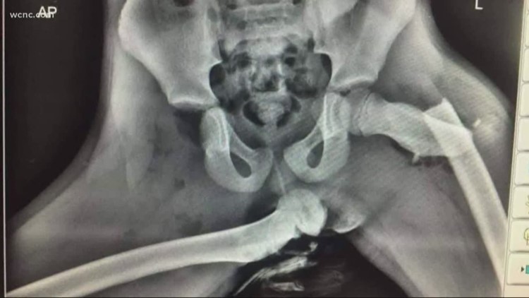 'Almost like sitting on a keg of dynamite' | X-ray of car crash injuries go viral